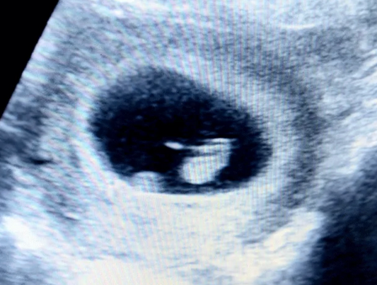 A Wonderful and Personal Journey to Pregnancy